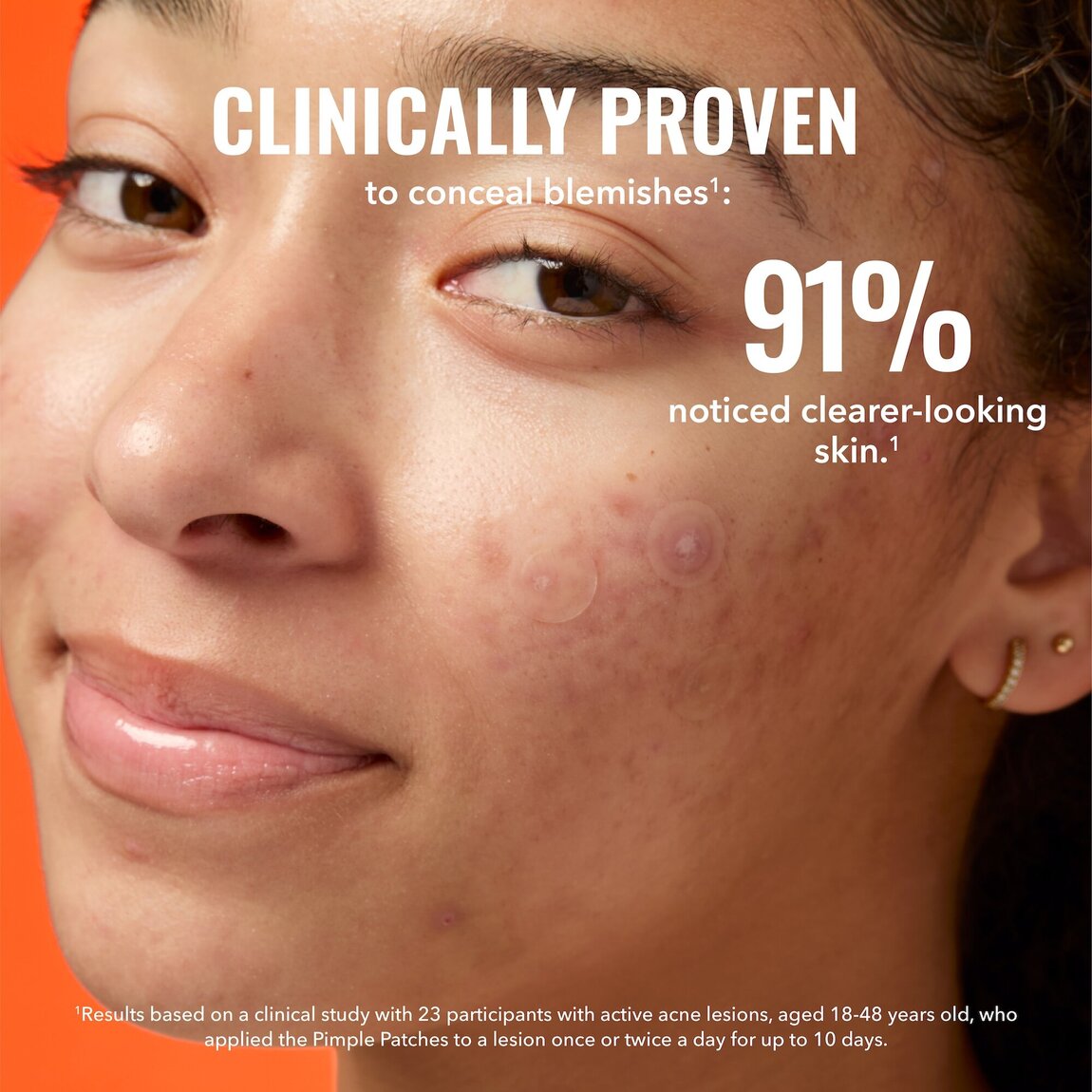 pimple-patches-a9 zb_p.jpg