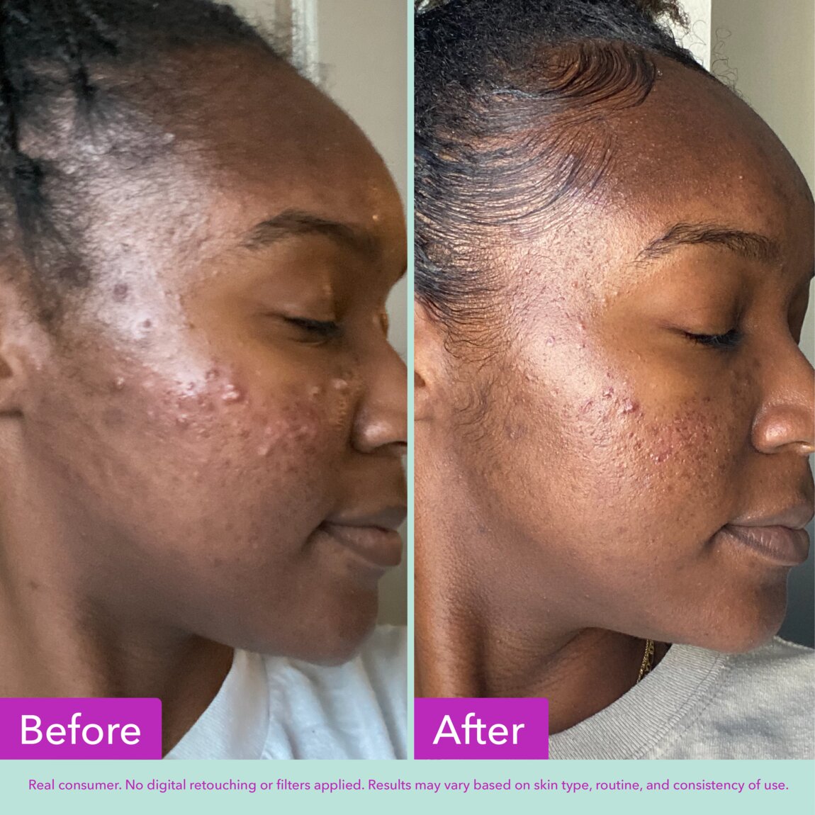 acne-foaming-cleanser-r7 zb_p.jpg